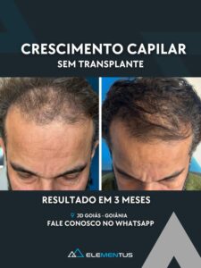 Resultado de tratamento capilar — Crescimento capilar sem transplante em 3 meses na Clínica Elementus Goiânia